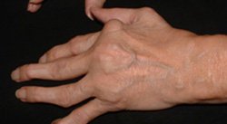 OSTEOARTRITIS